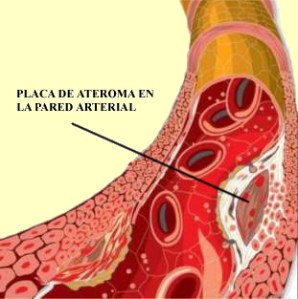 colesterol placa de ateroma