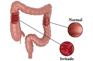 Colon-irritable1-500x325