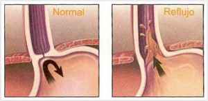 reflujo 4