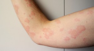 urticaria-brazo